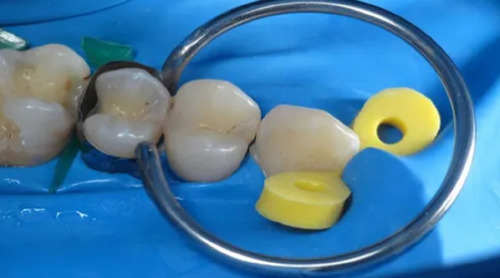 Imagen 6 de 6 de Banda Matrices Preformadas Odontología Anillo 100u Santiago