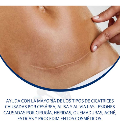 Gel De Silicona Para Eliminar Cicatrices De Cesárea Estrías Neutra