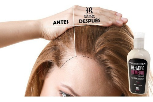 Imagen 2 de 9 de Pack Shampoo Hermoso Remedio ® Crecimiento Acelerado Anticaida Reparador Hidratante Anti Frizz Para Mujer 250ml Por 2 Unidades