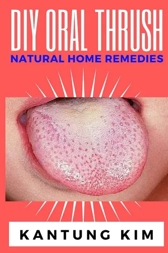 Libro De Remedios Caseros Naturales Para La Candidiasis Oral