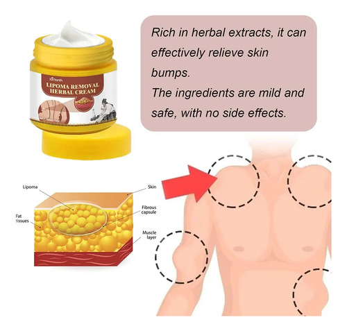 Crema Para Eliminar Bultos Subcutáneos Lipoma Cream, 20 G
