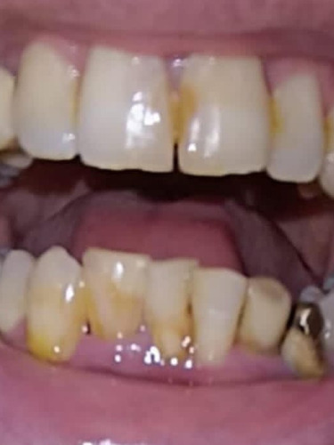 Corona Dental Zirconio