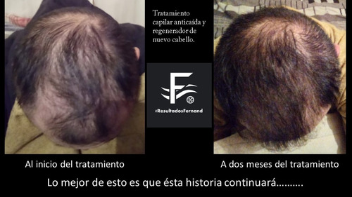 Solución Anticaida Para Hombre Con Cabello Normal