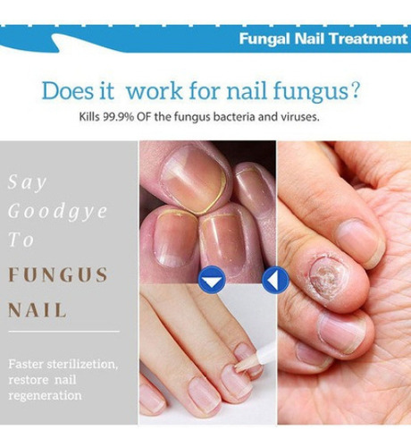 Bolígrafo Con Solución Antimicosis Y Anti Hongos En Las Uñas