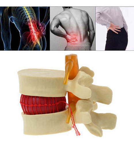 Modelo De Vértebras Lumbares: Columna Anatómica Hernia D