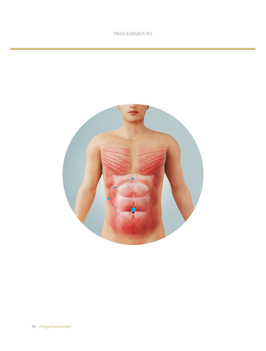 Atlas de Cirurgia Minimamente Invasiva e Robótica: Cirurgia Gastrointestinal, de Macedo, Antônio V.. Editorial Artmed Editora Ltda., capa mole em português, 2017