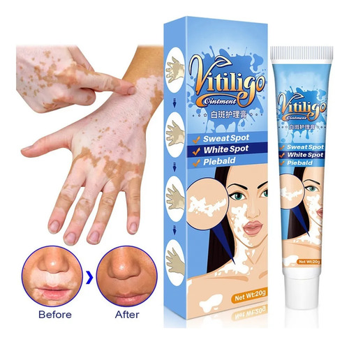 3 Creme De Vitiligo Para Remover Marcas De Pele.