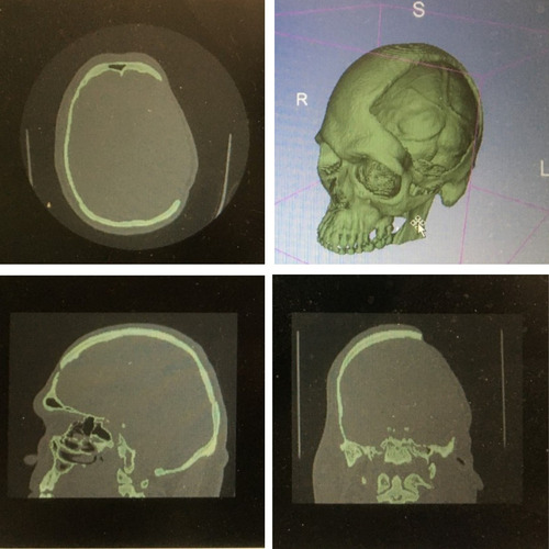 Imagen 4 de 6 de Implante De Pmma Especifico Para Craneoplastia - Guayaquil