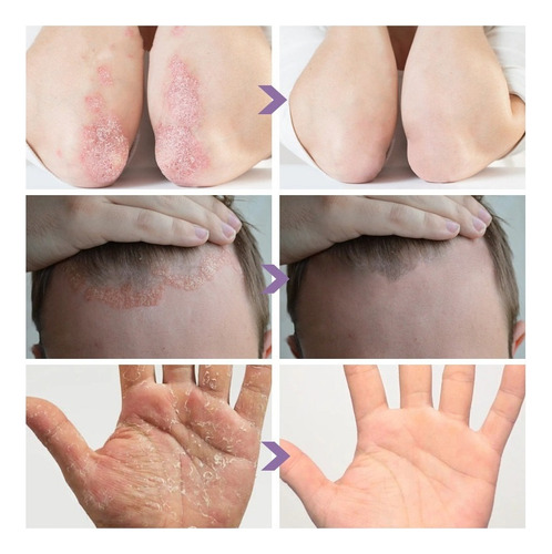 3×crema Hidratante Suave Para Psoriasis Con Neem