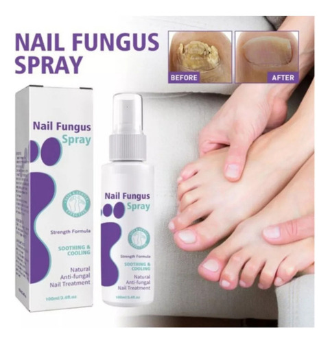 2x Spray Antifúngico Okdeals Spray Para Hongos En Las Uñas
