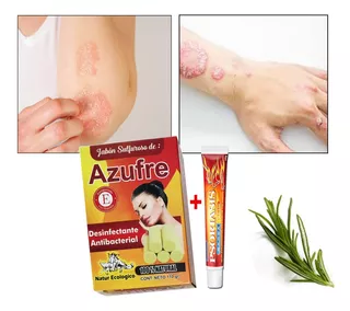 Tratamiento Para Soriasis, Dermatitis , Eccemas