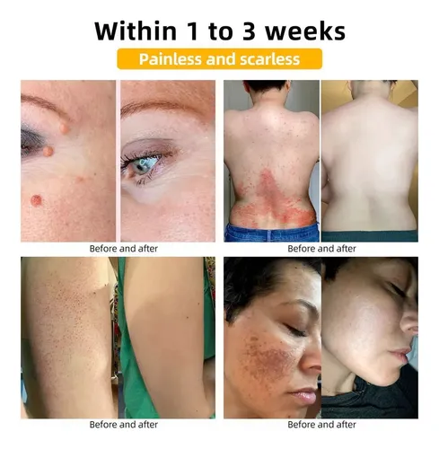5×crema Para Eliminar Etiquetas Veneno Abeja