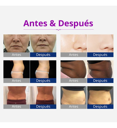 Multifuncional 6 En 1 Con Cavitación Ultrasónica 40k, Radiofrecuencia, Vacum Y Lipolaser De Alta Precisión, Manerales Robustos