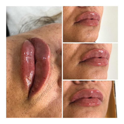 Imagen 3 de 5 de Relleno De Labios