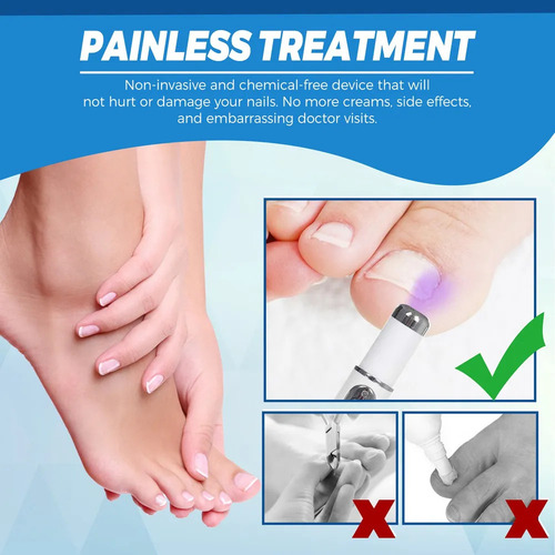 Bolígrafo Láser Hot Nail Fungus Pen Con Luz Azul