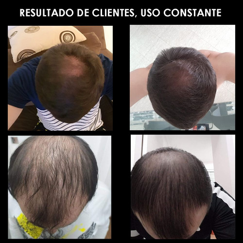 Kit Cronograma Capilar Tratamento Cabelo Antiqueda Aprovado