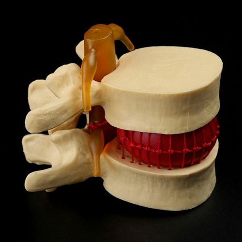 Modelo De Vértebras Lumbares: Columna Anatómica Hernia D