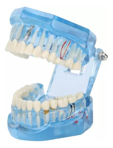 Implante Dental Manequim Modelo Odonto Boca Inteira.