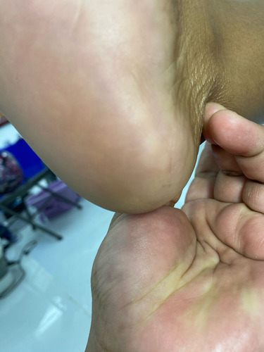 Removedor Hiperqueratosis Plantar Luxury Tratamiento