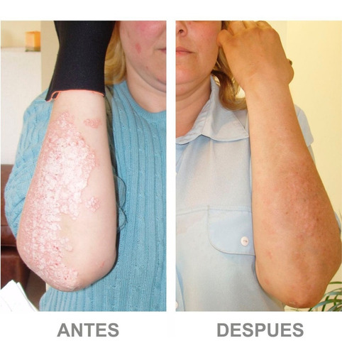 Psoriasis - 3 Cremas X 100g - Psor Dermabine®