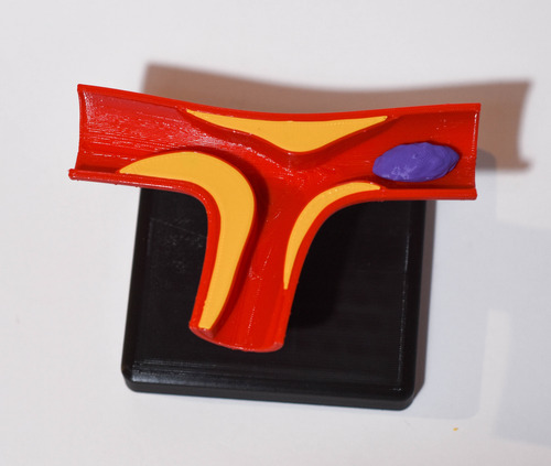 Maqueta Arteria Con Ateroma Semi Oclusivo - Medicina 3d