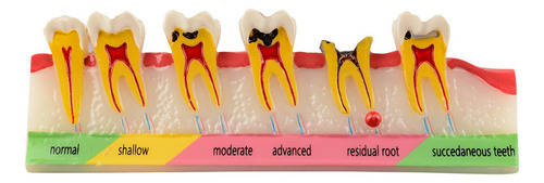 Modelo De Dientes En Desarrollo De Caries