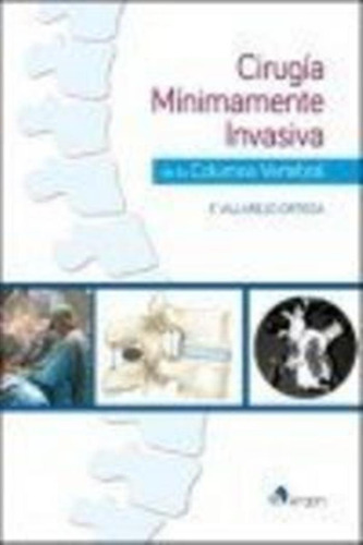 Cirugía Mínimamente Invasiva De La Columna Vertebral - Villa