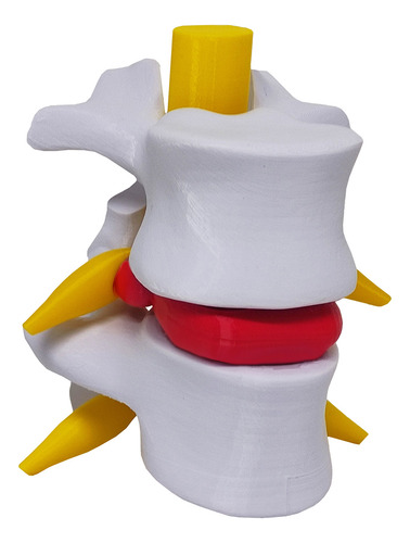 Modelo Anatômico Hérnia Disco Coluna Vertebral 3d