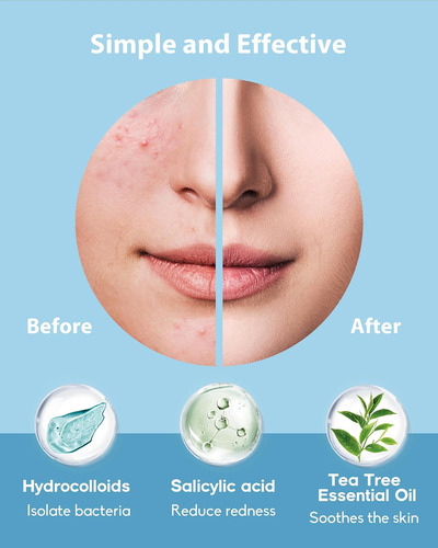 Csooze Acné Patches Pimple 4 Tamaños 210 Puntos Hidrocoloide