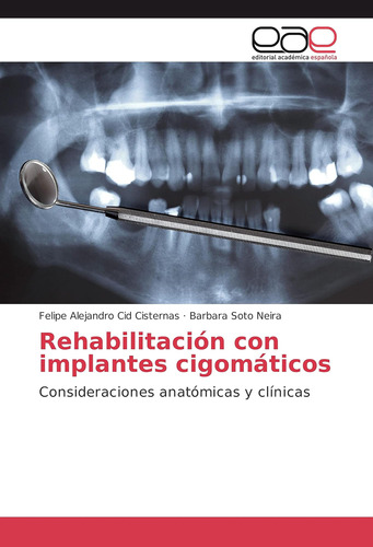 Libro: Rehabilitación Con Implantes Cigomáticos: Consideraci