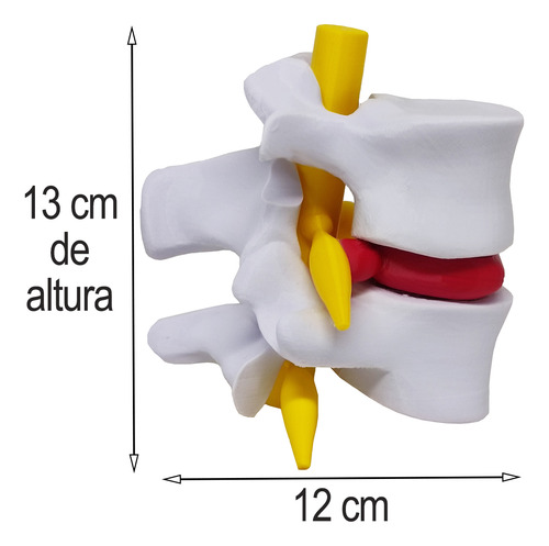 Modelo Anatômico Hérnia Disco Coluna Vertebral 3d