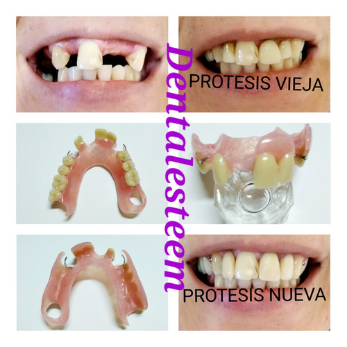 Imagen 4 de 5 de Prótesis Dentales Dentista Placas De Contencion Y Bruxismo