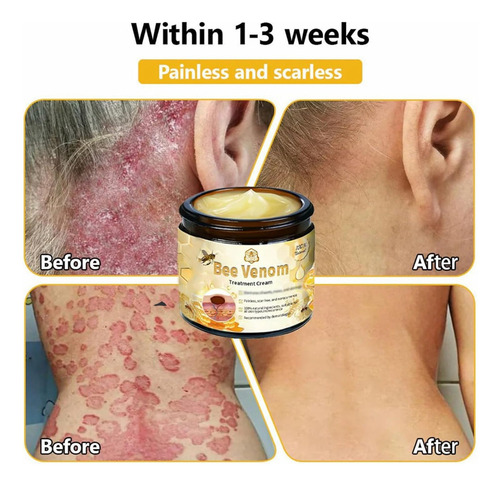 Crema Para El Tratamiento De La Piel De Abeja, Reduce Eficaz