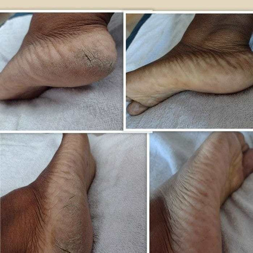 Imagem 1 de 5 de Plástica Dos Pés