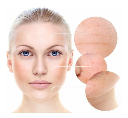 Imagen 2 de 7 de Gel Mandelico Para Manchas Marcas Cicatrices De Acne Idraet