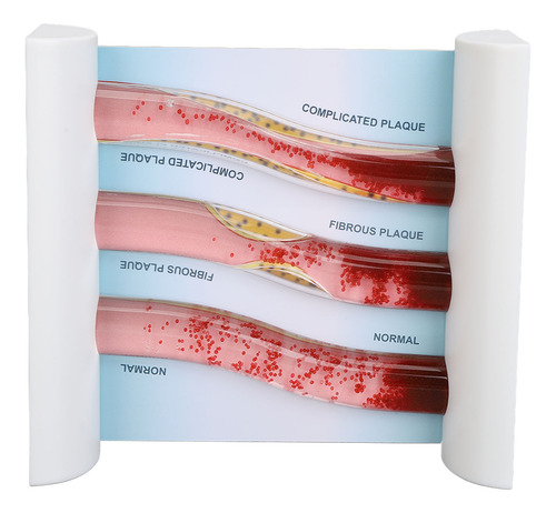 Lípido De Baja Densidad Ldl Modelo De Vaso Sanguíneo Lipopro
