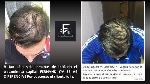 Solución Anticaida Para Hombre Con Cabello Normal