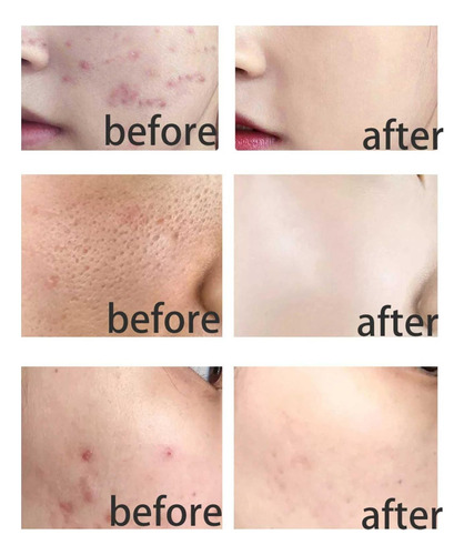 The Ordinary Niacinamida 10% y zinc 1% Serum Facial Anti-manchas Despigmentante Con Niacinamida Para Todo Tipo De Piel Incluso Piel Sensible día noche Para Todo Tipo De Piel 30 Ml