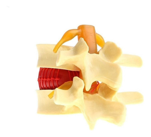 . 2x Modelo De Hernia De Disco Lumbar De La Columna