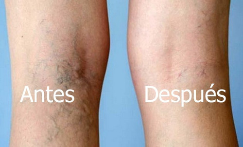 Varikosette - Hendel - Crema Para Venas Varicosas, Varices
