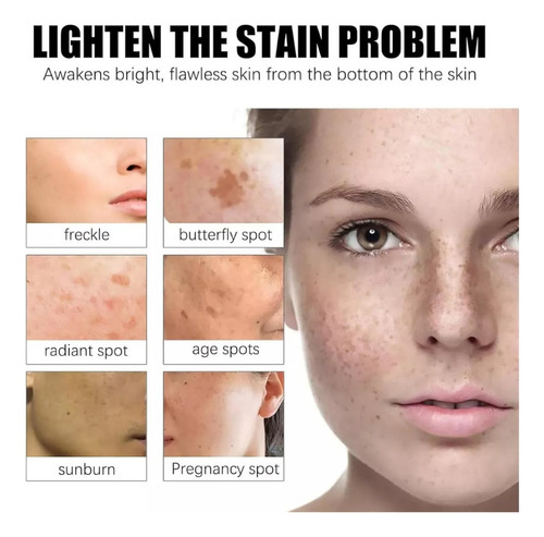 Crema De Urea Que Decolora Las Manchas, Crema De Urea Con*3