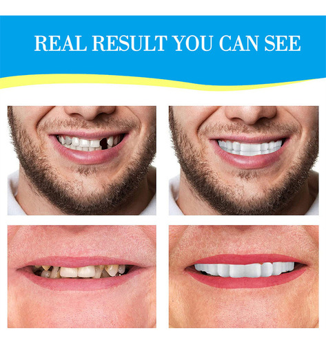 2 Peças De Aparelho Dentário De Proteção Noturna Superior Pa