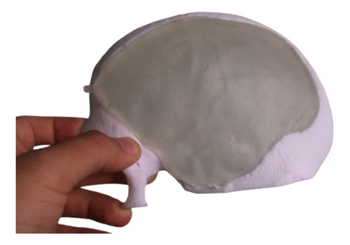 Imagen 5 de 6 de Implante De Pmma Especifico Para Craneoplastia - Guayaquil