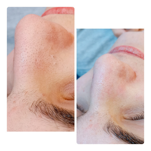 Limpieza Facial Profunda En Sáenz Peña, 3 De Febrero