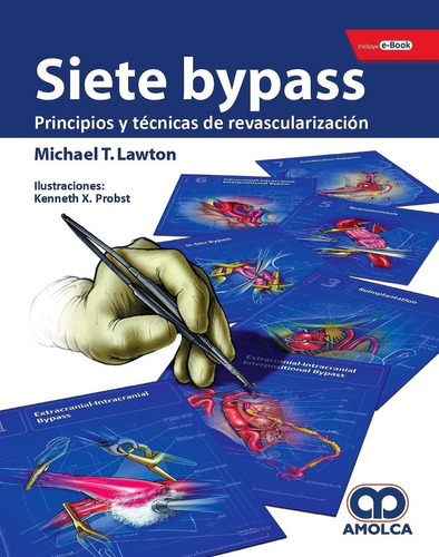 Siete Bypass Revascularización Lawton Nov 2019 Envíos T/país