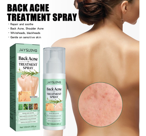 I Back Acne Cure, Cura El Acné Corporal Con Ácido Salicílico