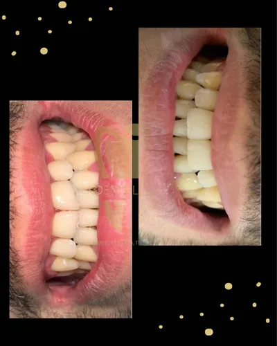 Carilla Dental En Resina (precio Por Unidad)