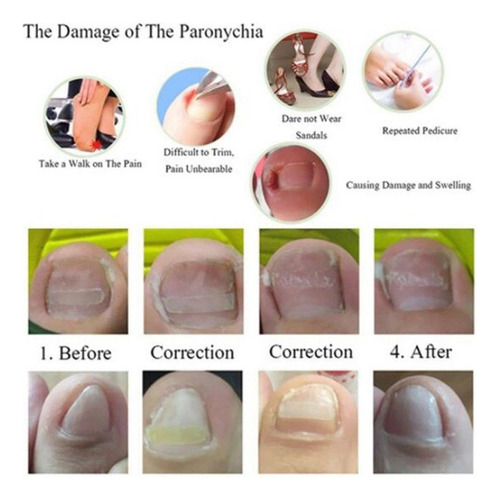 Parches De Corrección De Uñas Pies Encarnadas. Herramienta