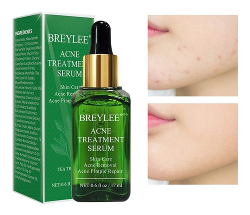 Tratamiento Para Acne Serum Comedones Pieles Grasas 100% Usa