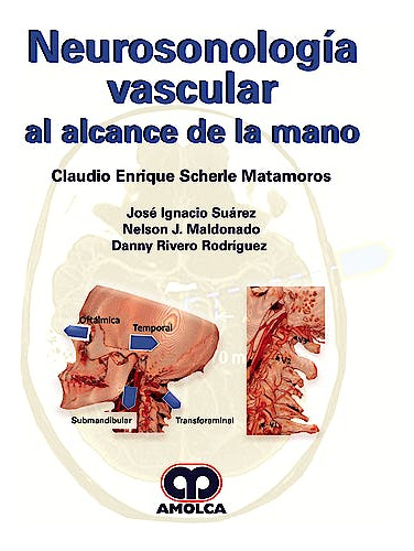 Neurosonologia Vascular - Scherle - Amolca